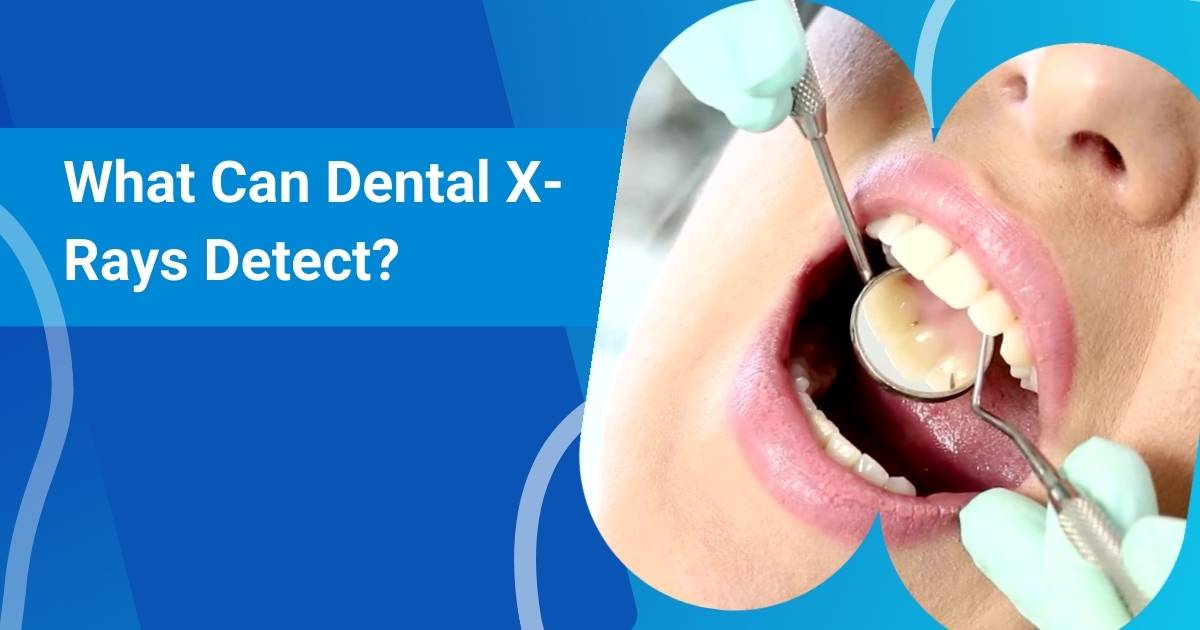 What Can Dental X-Rays Detect