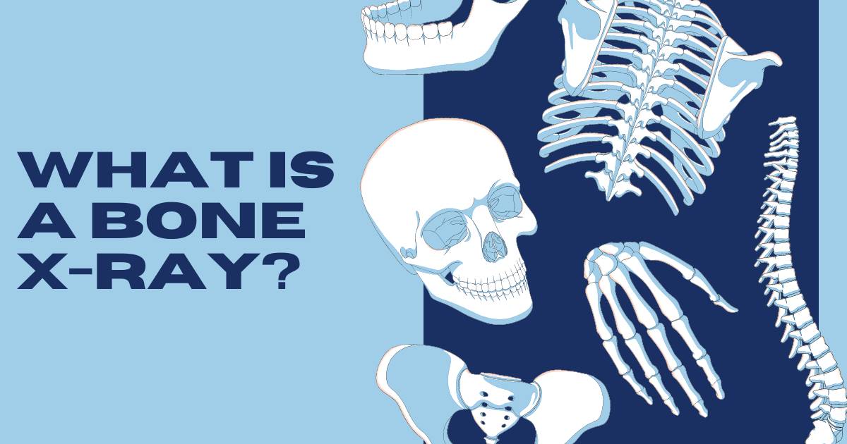 What is a Bone X-ray